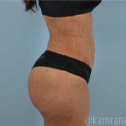 Brazilian Butt Lift Before & After Patient #1636