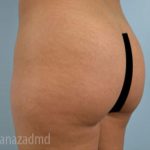 Brazilian Butt Lift Before & After Patient #1636
