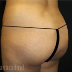 Brazilian Butt Lift Before & After Patient #1637