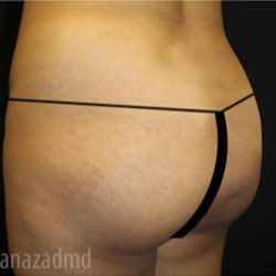 Brazilian Butt Lift Before & After Patient #1637