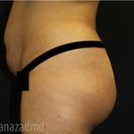 Brazilian Butt Lift Before & After Patient #1637