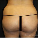 Brazilian Butt Lift Before & After Patient #1637
