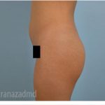 Brazilian Butt Lift Before & After Patient #1639