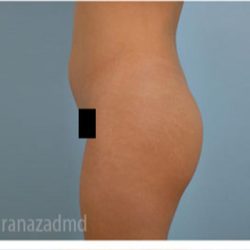 Brazilian Butt Lift Before & After Patient #1639