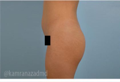 Brazilian Butt Lift Before & After Patient #1639