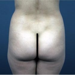Brazilian Butt Lift Before & After Patient #1640