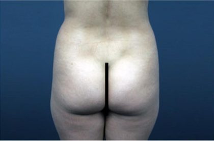 Brazilian Butt Lift Before & After Patient #1640