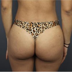 Brazilian Butt Lift Before & After Patient #1640