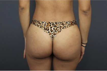 Brazilian Butt Lift Before & After Patient #1640