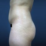 Brazilian Butt Lift Before & After Patient #1640