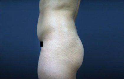 Brazilian Butt Lift Before & After Patient #1640