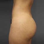 Brazilian Butt Lift Before & After Patient #1640