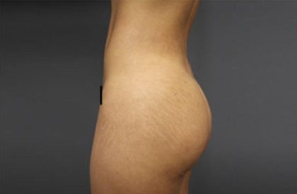 Brazilian Butt Lift Before & After Patient #1640