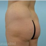 Brazilian Butt Lift Before & After Patient #1642