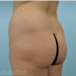 Brazilian Butt Lift Before & After Patient #1642