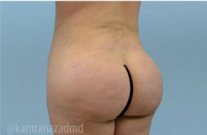 Brazilian Butt Lift Before & After Patient #1642