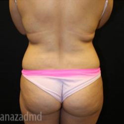 Brazilian Butt Lift Before & After Patient #1643