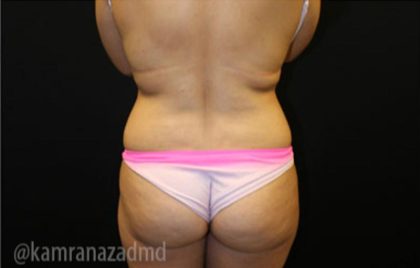 Brazilian Butt Lift Before & After Patient #1643