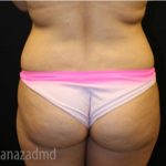 Brazilian Butt Lift Before & After Patient #1643