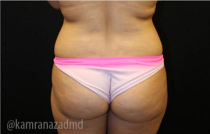 Brazilian Butt Lift Before & After Patient #1643