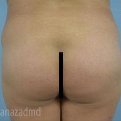 Brazilian Butt Lift Before & After Patient #1645