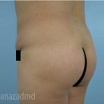 Brazilian Butt Lift Before & After Patient #1645