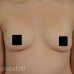 Breast Augmentation Before & After Patient #2126