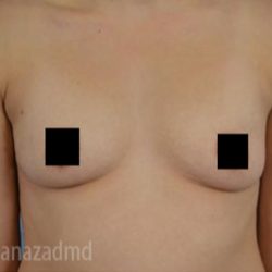 Breast Augmentation Before & After Patient #2126