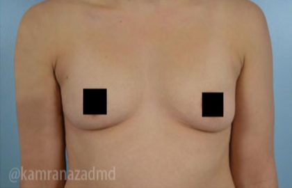 Breast Augmentation Before & After Patient #2126