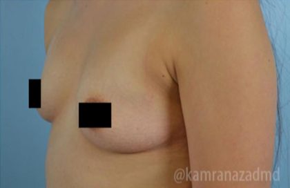 Breast Augmentation Before & After Patient #2126