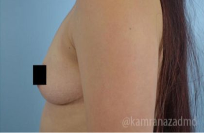 Breast Augmentation Before & After Patient #2126