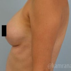 Breast Augmentation Before & After Patient #2127