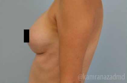 Breast Augmentation Before & After Patient #2127