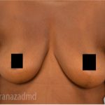 Breast Augmentation Before & After Patient #2128