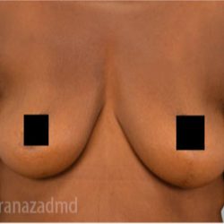 Breast Augmentation Before & After Patient #2128