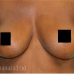 Breast Augmentation Before & After Patient #2128