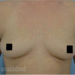 Breast Augmentation Before & After Patient #2129
