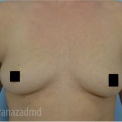 Breast Augmentation Before & After Patient #2129