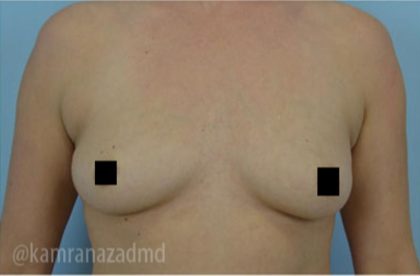 Breast Augmentation Before & After Patient #2129