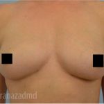 Breast Augmentation Before & After Patient #2129