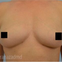 Breast Augmentation Before & After Patient #2129