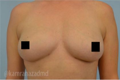 Breast Augmentation Before & After Patient #2129