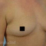 Breast Augmentation Before & After Patient #2129