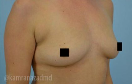 Breast Augmentation Before & After Patient #2129
