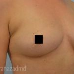 Breast Augmentation Before & After Patient #2129
