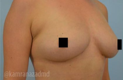Breast Augmentation Before & After Patient #2129