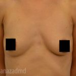 Breast Augmentation Before & After Patient #2130