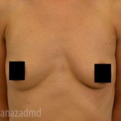 Breast Augmentation Before & After Patient #2130