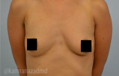 Breast Augmentation Before & After Patient #2130