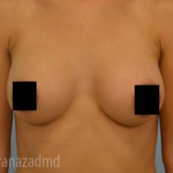 Breast Augmentation Before & After Patient #2130
